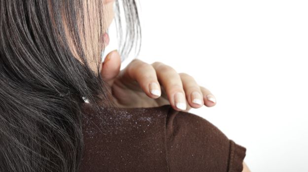 How to remove Dandruff